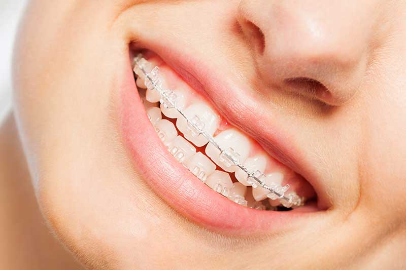 Clear Braces - Belmont Orthodontics